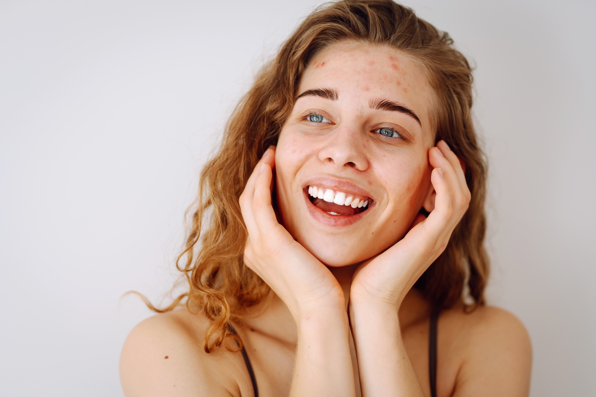 Close-up portrait of a beautiful woman without makeup with imperfect skin. Acne skin. Natural beauty